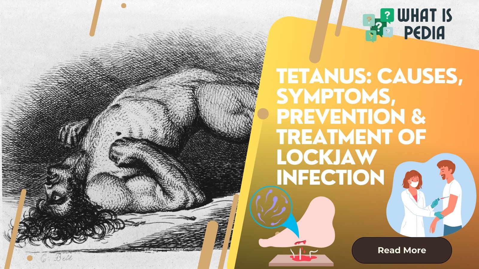 Tetanus